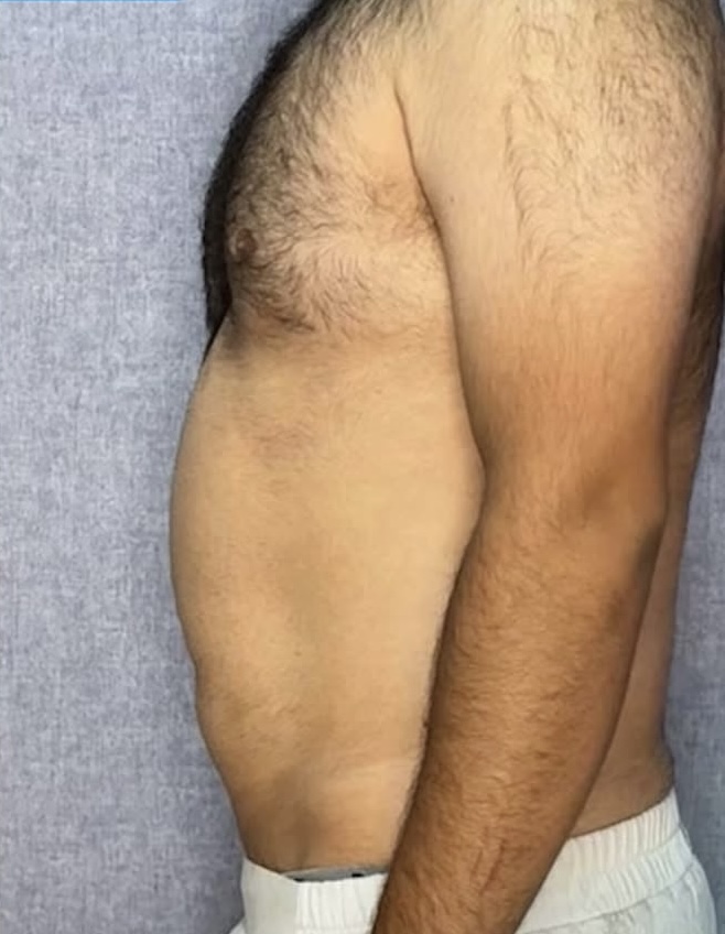 نمونه ای از لاغری موضعی شکم و پهلو